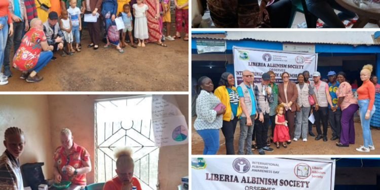 Liberia Albino Society Celebrates 10th International Albinism Awareness Day, Reminds President Boakai To Live Up To His Promise