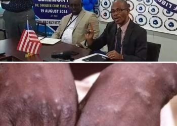 NPHIL Confirms One Monkey Pox Case, Describes Previous Media Reports As Untrue And Inaccurate