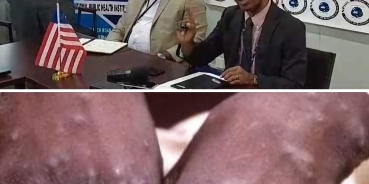 NPHIL Confirms One Monkey Pox Case, Describes Previous Media Reports As Untrue And Inaccurate